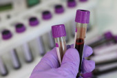 Naučnici razvili revolucionarni test: Depresiju moguće utvrditi analizom krvi