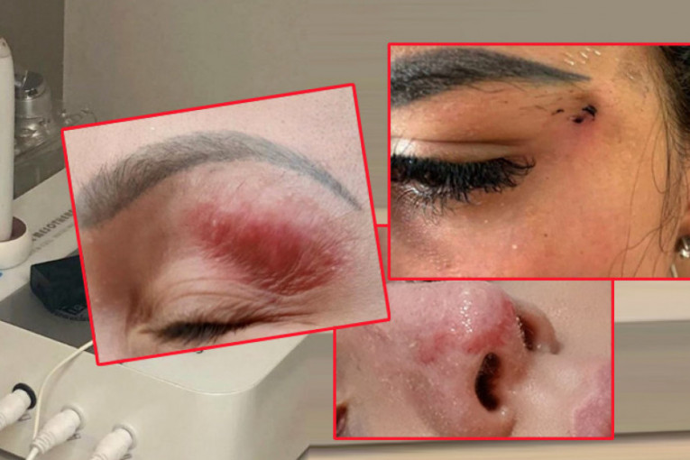 Žene objavile užasne fotografije posle kozmetičkog tretmana: Žalile se na kraste, podlive, ali šta je prava istina?
