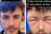 Mladić pokazao kako izgleda alergija na farbu za kosu, pa apelovao: Obavezno testirajte pre nanošenja (VIDEO)