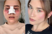 Kakva transformacija! Devojka pokazala rezultate pre i posle operacije nosa, ljudi ne veruju da se radi o istoj osobi
