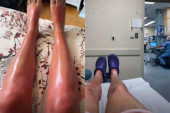 Ovoj devojci je sasvim običan ritual za negu kože pretvorio sunčanje u bolest: Ne radite ovo!