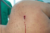 Metak u leđima: Prve fotografije teško ranjenog Srećka Sofronijevića (FOTO/VIDEO)