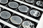 Istraživači prvi put snimili šta se dešava sa mozgom kada umremo: Ovo otkriće bi moglo da objasni naše poslednje trenutke života