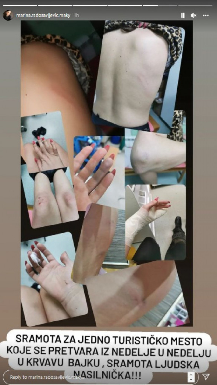 Oglasila se pretučena pevačica: Preplašena sam, danima su me pratili! Može biti samo jedan motiv za ovo nasilje!