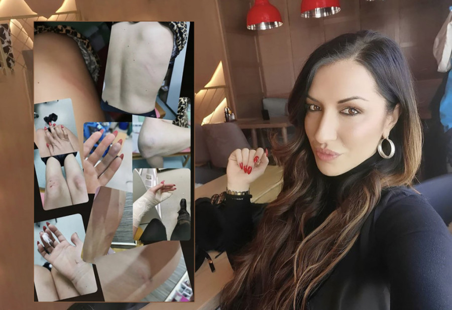 Šamari, pocepane usne i frakture! Tri srpske pevačice doživele nasilje od početka godine