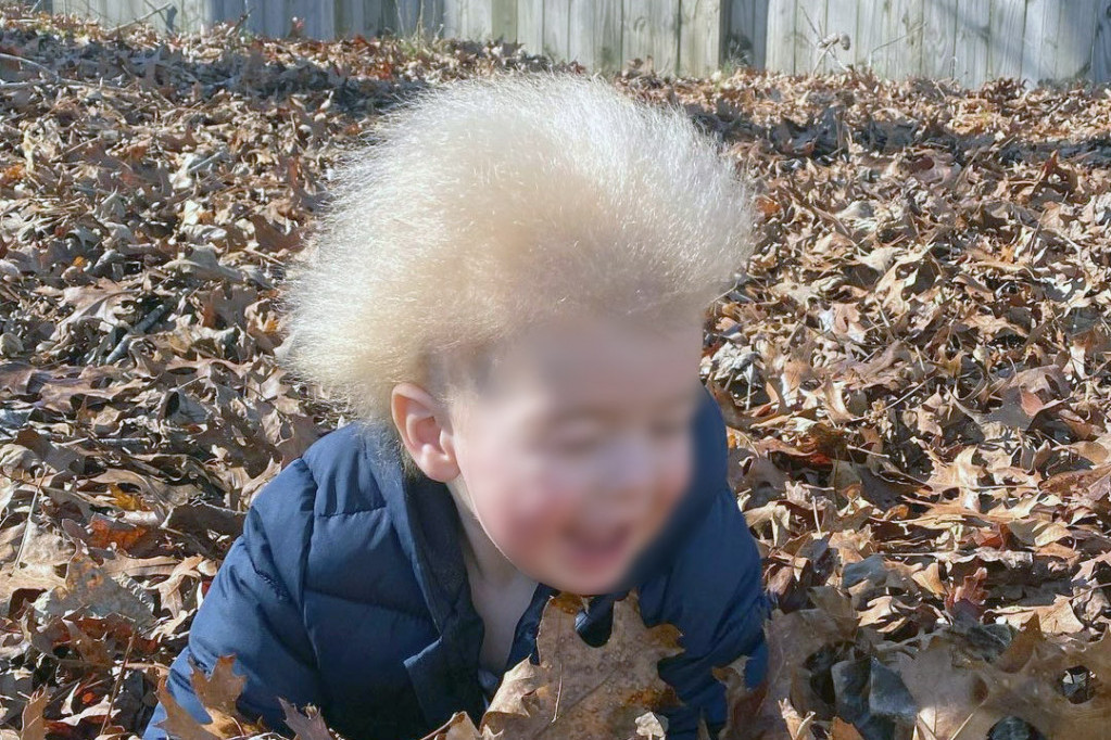 Dečak sa sindromom neočešljane kose hit na Instagramu: Isto stanje imao je i Ajnštajn