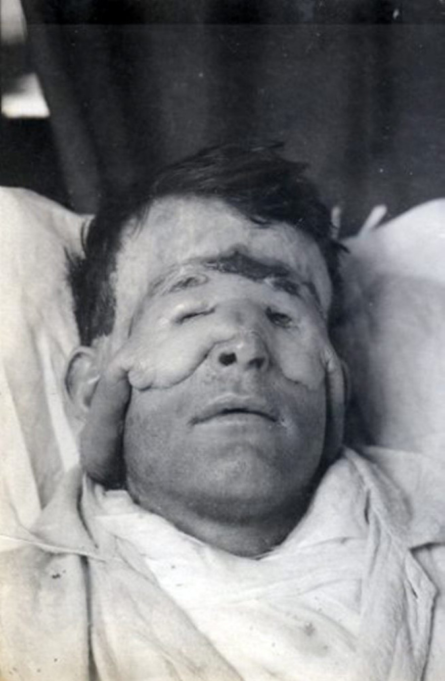 Mornar Valter Jeo je prva osoba u istoriji koja se podvrgla modernoj plastičnoj hirurgiji (FOTO)