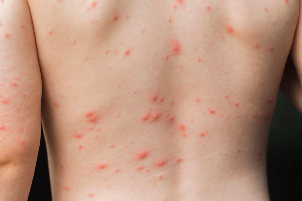 Ispovest veterinara koji je preležao majmunske boginje: Bilo je zastrašujuće, plašio sam se da ne izgubim palac