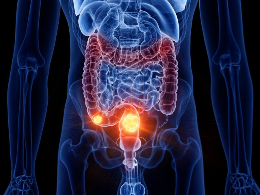 Prvi ekspertski sastanak posvećen digestivnoj onkologiji u Beogradu: Kako smanjiti mortalitet od raka na Balkanu