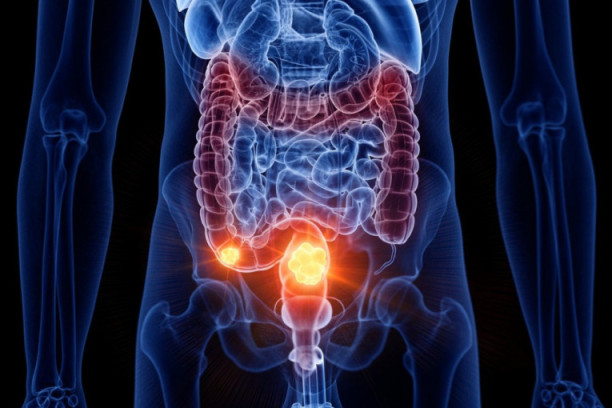 Otkriven novi lek protiv raka: Šta se sve zna o novoj terapiji i kada bi mogla da počne da se primenjuje u Srbiji!