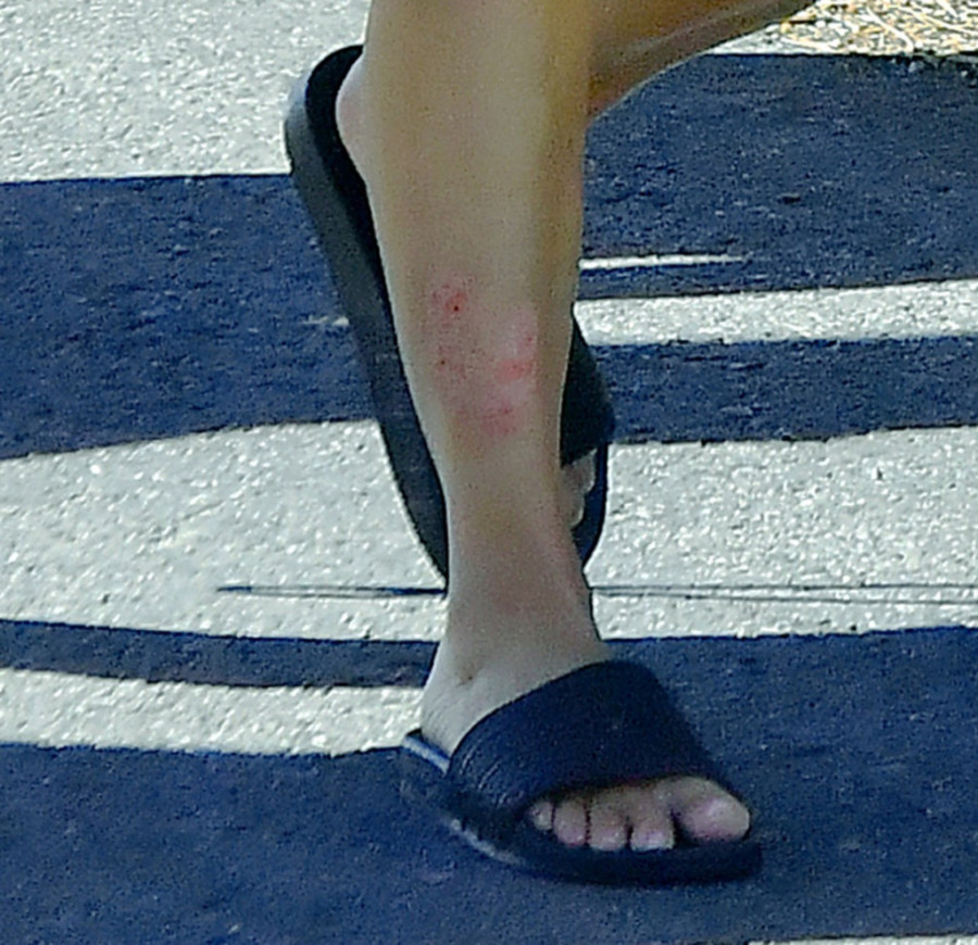 Kako se Kim u stvari nosi s ovim oboljenjem? Velika ispovest najpoznatije Kardašijanove: Nema više skrivanja šminkom!