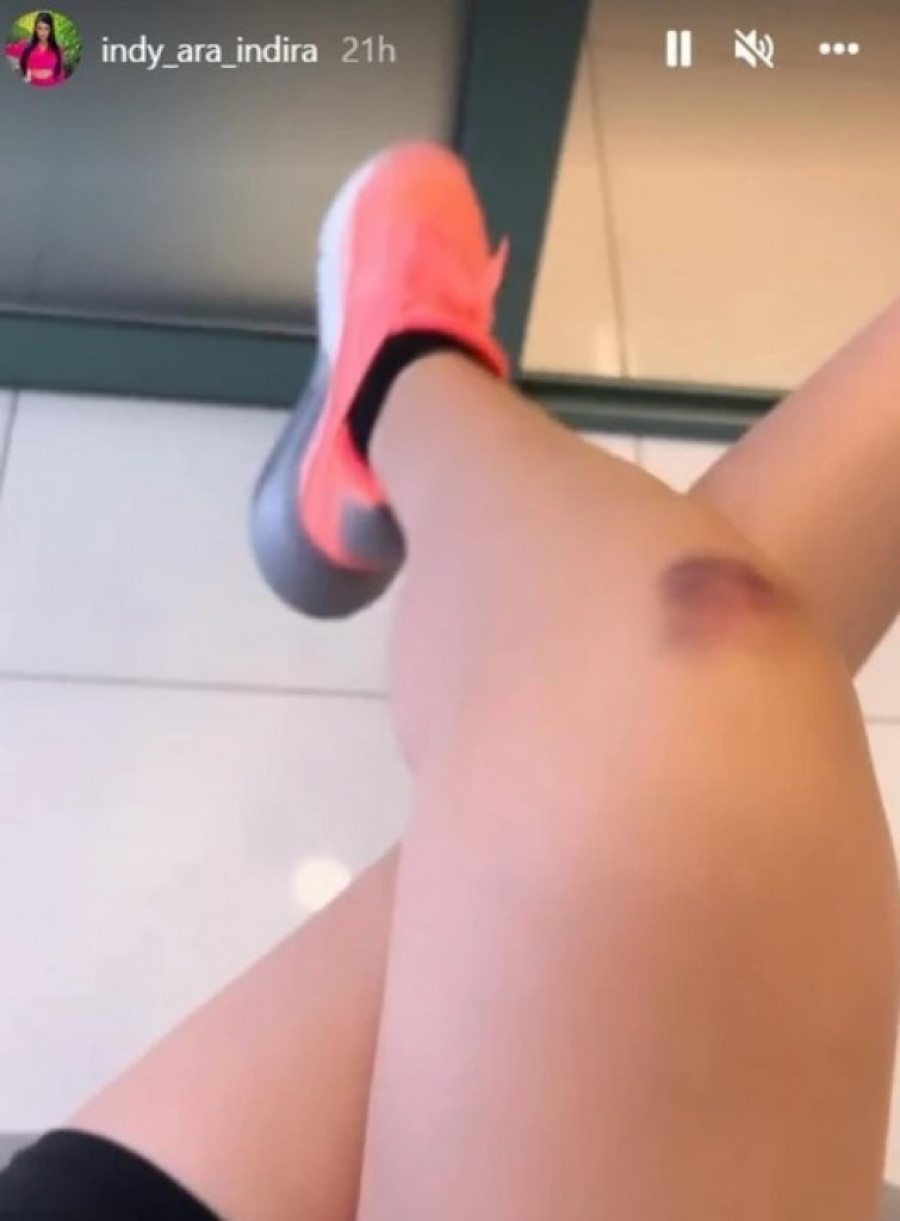 Posle Rade razbila se i Indi! Pevačica pokazala modrice: Pala i ubila se (FOTO)