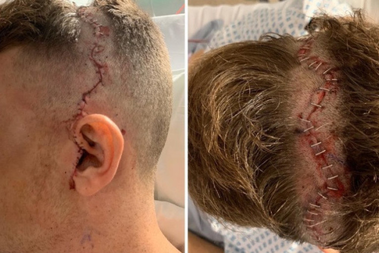 Horor povreda Engleza, oslepeo od udarca lopte u oko! Doktori mu stavili 60 kopči i ubacili 31 šraf u lobanju!