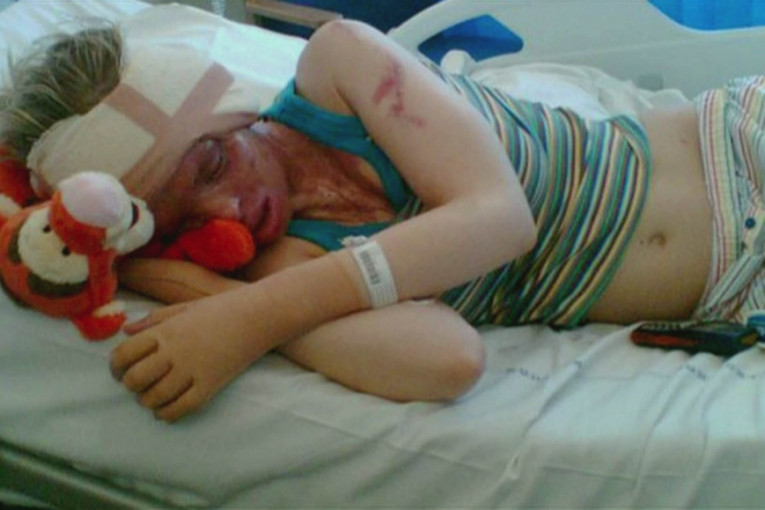 Dečko ju je silovao osam sati, pa je polio kiselinom: Ovako izgleda posle 400 operacija (FOTO)