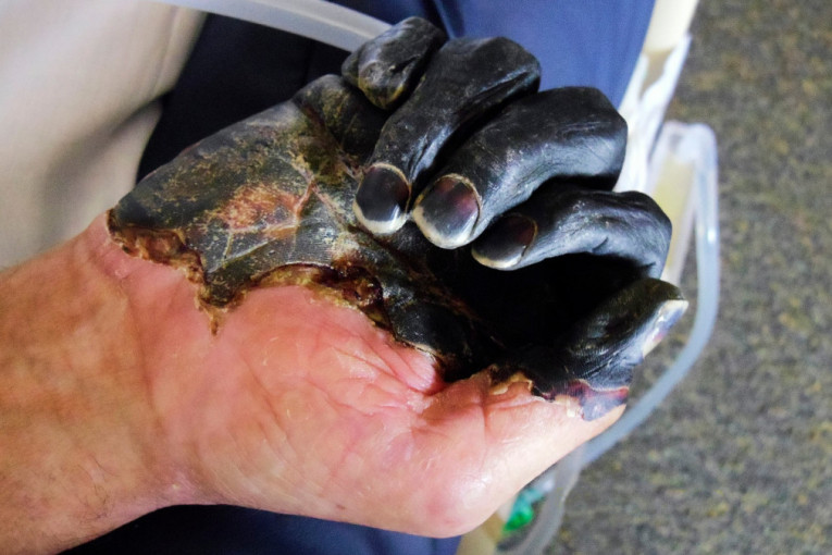 "Crna smrt"! U SAD se pojavila bolest koja je ubila milione ljudi u srednjem veku