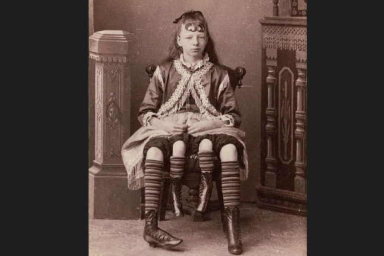 Četvoronoga devojčica je bila cirkusko čudovište: Rodila je petoro dece i umrla kao dama (FOTO)