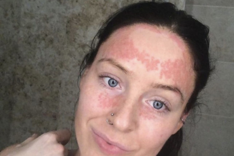 Kako se pokreće psorijaza – i zašto je ovo bolest celog organizma