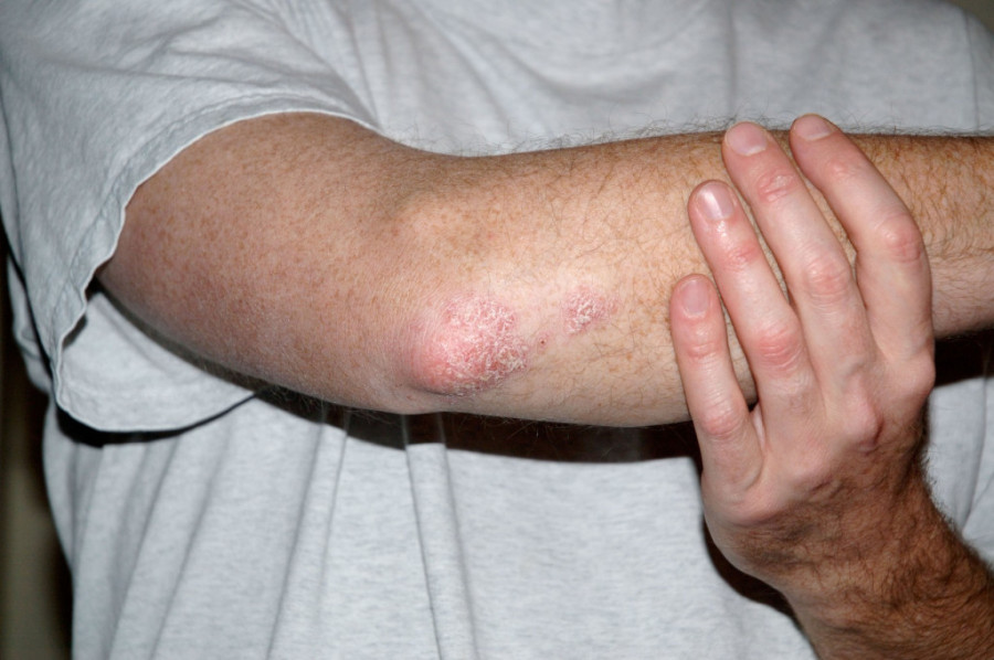 Kako se pokreće psorijaza – i zašto je ovo bolest celog organizma