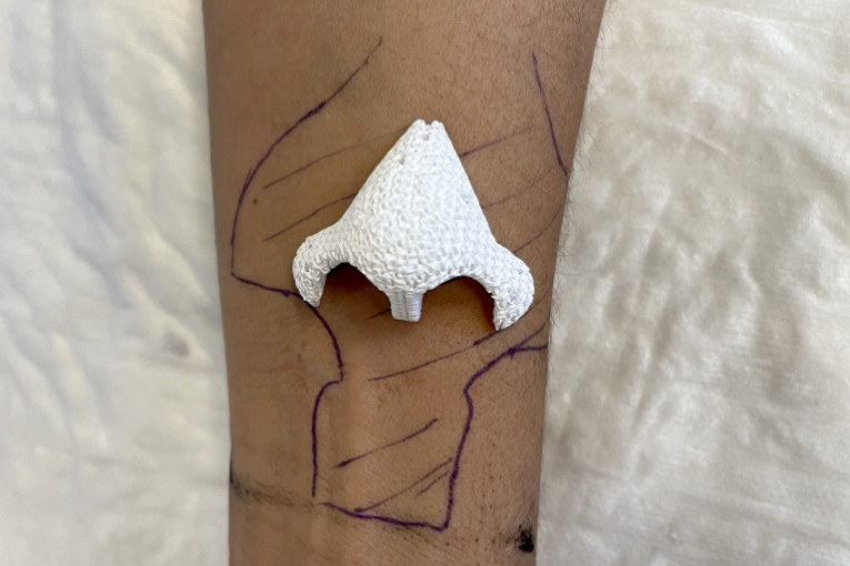 Neverovatno! Lekari ženi zbog raka odstranili nos, a onda su uzgajali nov na podlaktici i - "izrastao je" (FOTO)