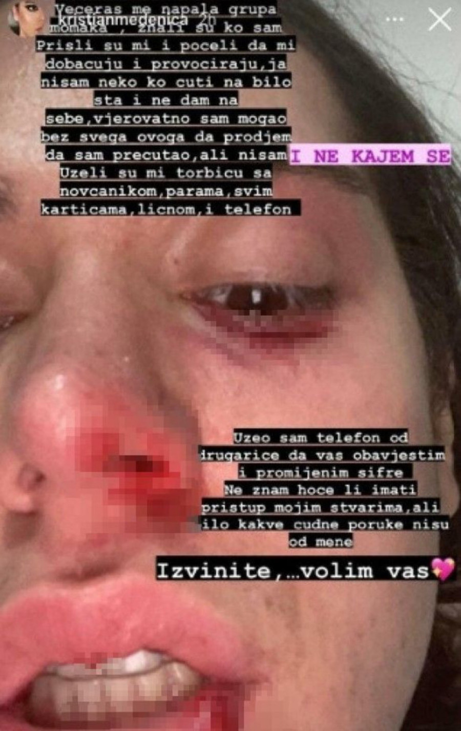 Pretučen poznati tiktoker: Podlivi ispod oka, pocepana usna (FOTO)