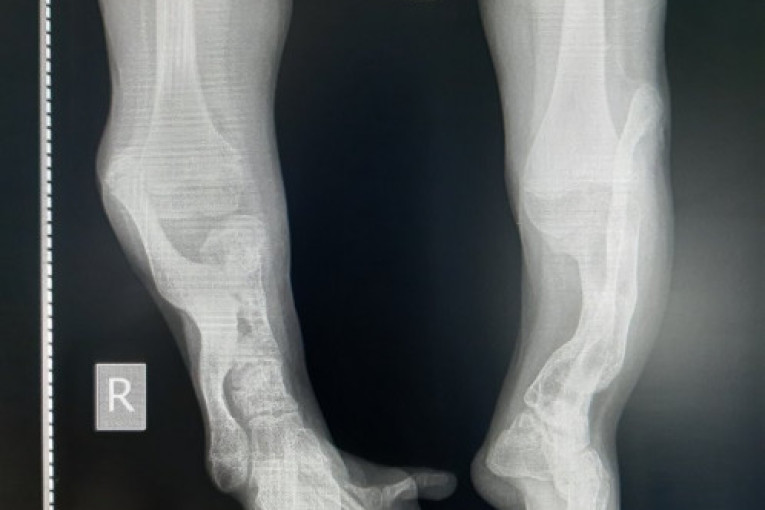 Andreja ima samo 14 godina, a operisana je već 25 puta: Majka je ostavila, otac brine o njoj i još dvoje dece, a žive od socijalne pomoći