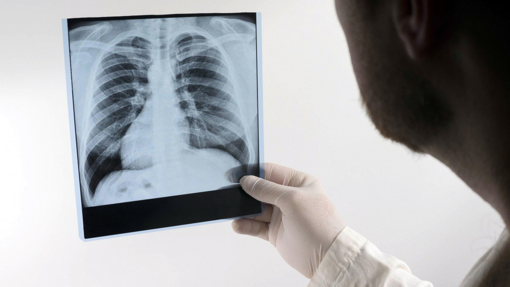 Posle Kine, i u Evropu stigla bolest "sindrom belih pluća"! Otporna je na penicilin, govori se o novoj epidemiji, deca najugroženija