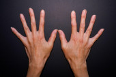Llinije na noktima, perut i desni koje krvare: Telo šalje signale koji mu vitamini nedostaju