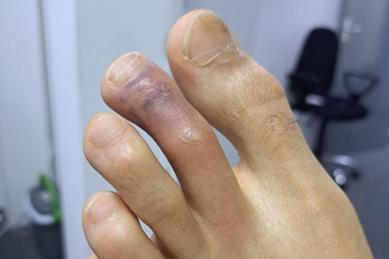 Evo odgovora Špancima koji tvrde da Eksum nije povređen! Idol navijača Partizana igrao pod neopisivim bolovima! (FOTO)