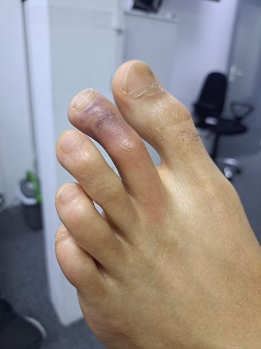 Evo odgovora Špancima koji tvrde da Eksum nije povređen! Idol navijača Partizana igrao pod neopisivim bolovima! (FOTO)