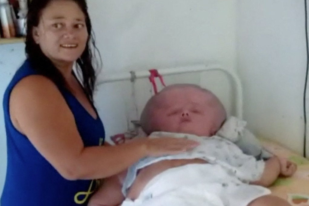 Majka „džinovske bebe" kritikovana što objavljuje njene fotografije: Predviđali su da će živeti tri meseca, a napunila je 29 godina