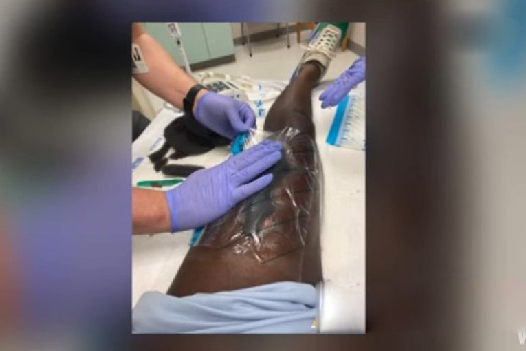 Rođak mu napravio pakao od života: Ugrizao ga za nogu i zarazio bakterijom koja proždire meso (VIDEO)