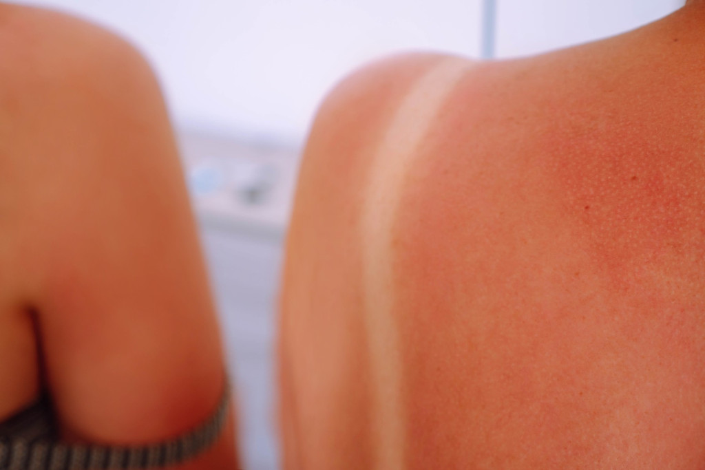 Novi trend na plažama! Mažu se pivom za lepši ten! Doktori upozoravaju: To je budalaština, možete samo da dobijete rak kože!