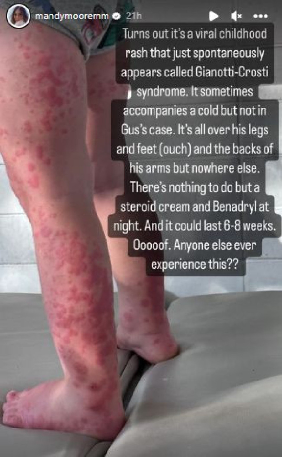 „Probudio se ovakav..." Mendi Mur otvoreno o zdravstvenom stanju dvogodišnjeg sina: Fotografijama šokirala sve (FOTO)