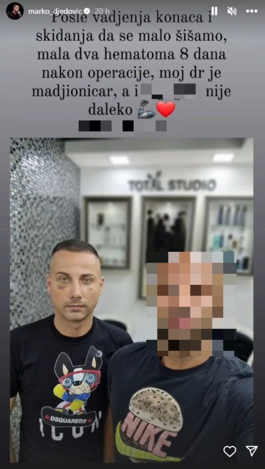 Marko Đedović skinuo zavoje! Pokazao kako izgleda osam dana posle zahvata, pa nastavio sređivanje pred „Elitu": Moj doktor je mađioničar!