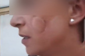 Uhapšen siledžija iz Sremske Mitrovice: Bivšu ženu presreo na ulici pa je izujedao po obrazu