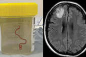 Ženi iz mozga izvukli crva od 8 cm! Ovo je prvi takav slučaj u svetu
