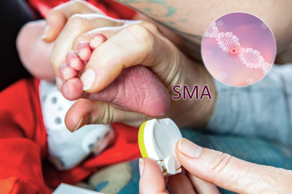 Prvi put od uvođenja obaveznog skrininga u Srbiji: Registrovana prva beba pozitivna na SMA