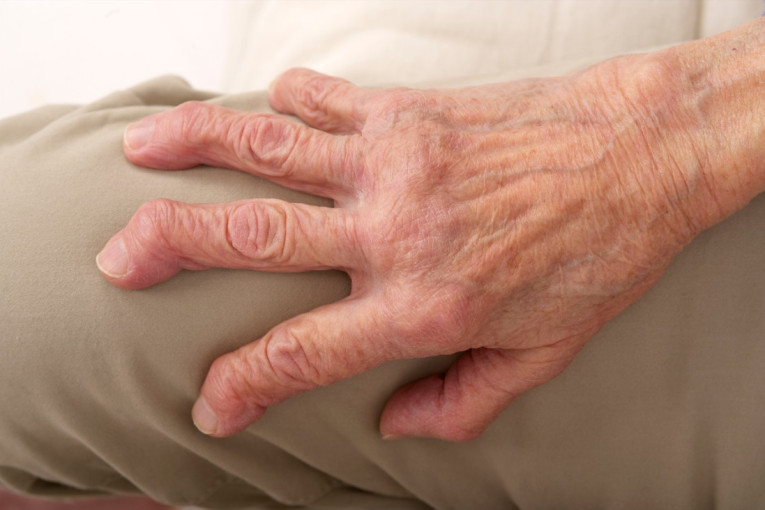 Na Svetski dan borbe protiv artritisa u Srbiji 70.000 obolelih od bolesti koja "krivi" prste na rukama