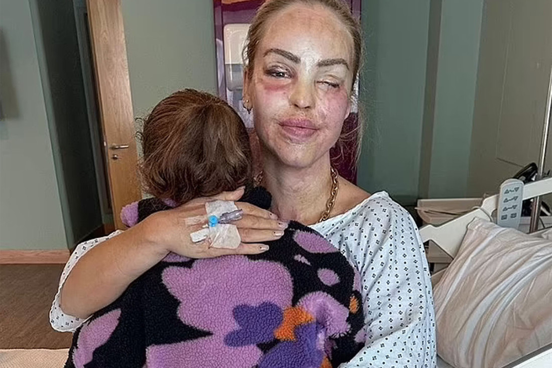 Voditeljka podelila fotografije oporavka nakon što joj je Stefan bacio kiselinu u lice! Sudija: Vaše lice je oličenje zla!