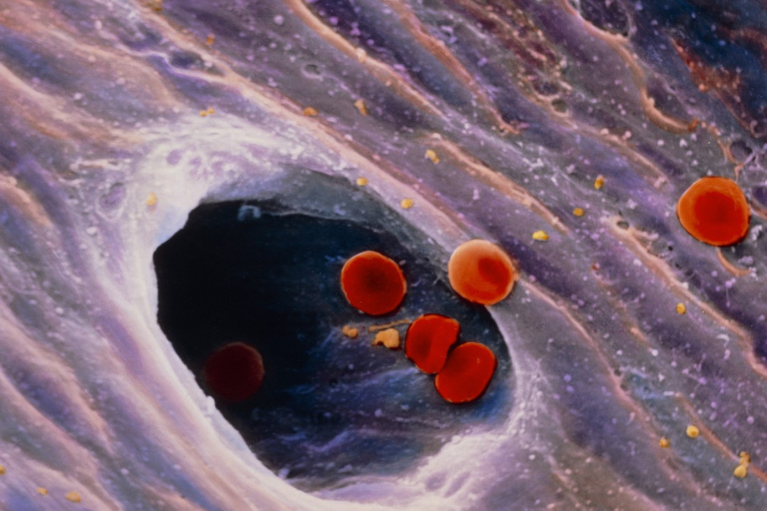 Maja je među 1.200 ljudi koliko ih godišnje oboli od opake bolesti: Oteklinu na glavi nije shvatala ozbiljno, a onda je otišla kod lekara...