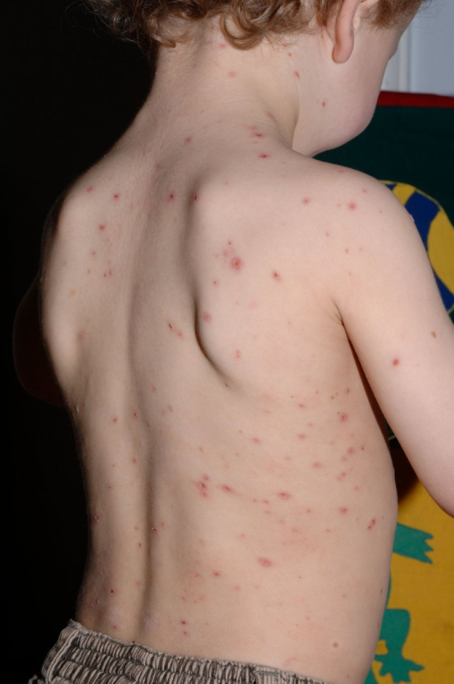 "Batut" objavio najnovije podatke: U Srbiji registrovano 27 slučajeva morbila