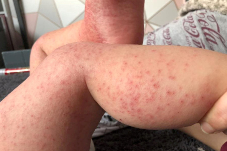 Male boginje se šire po Srbiji! Epidemiološkinja upozorila koliko je situacija alarmantna