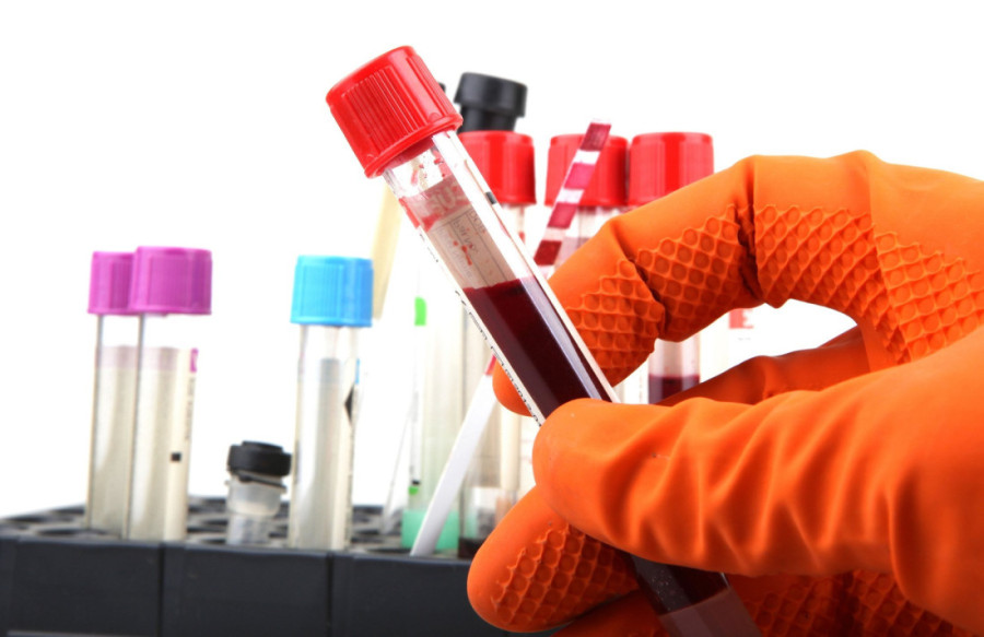 Dolazi proleće, vreme je za sistematski: Koliko često treba vaditi krv i koja odstupanja od referentnih vrednosti su normalna