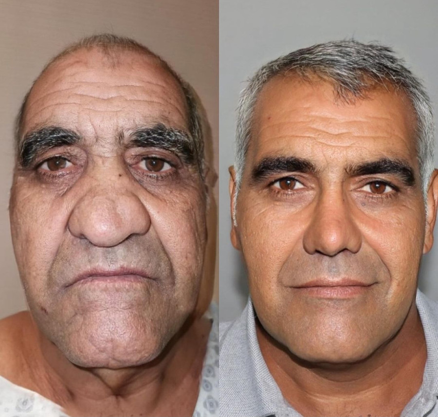 Nisi ružan, samo nemaš para: Kako je najružniji čovek postao Džordž Kluni zahvaljujući plastičaru - ljudi gledaju u neverici (FOTO)