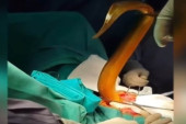 Horor u bolnici! Lekari izvadili 65-centimetarsko čudovište iz stomaka pacijenta (FOTO)