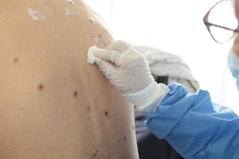 SZO dala zeleno svetlo: Partneri mogu da kupuju vakcine protiv mpoksa pre odobrenja