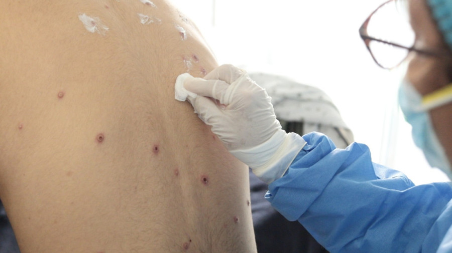 Ubrzano razvijanje vakcine protiv majmunskih boginja: Odobrena klinička ispitivanja