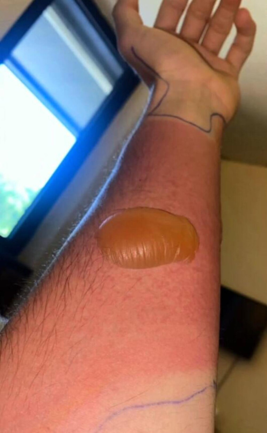 Marko doživeo šok kada se probudio i ugledao ovo na ruci: Odlaskom u bolnicu počela je agonija!