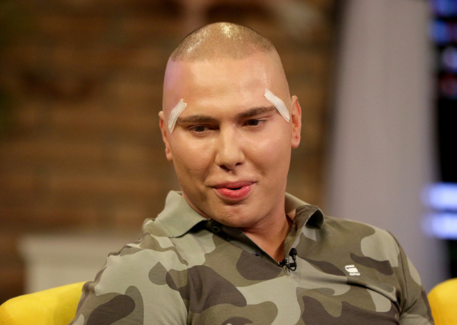 Rođena majka ga ne bi prepoznala! Ovako je Brendon izgledao pre svih estetskih intervencija (FOTO)