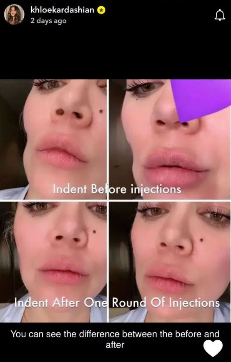 Kloi posle operacije tumora ostala s udubljenjem na licu! Sad pokazala kako izgleda bez šminke, te čime je „popravila stanje"! (FOTO)